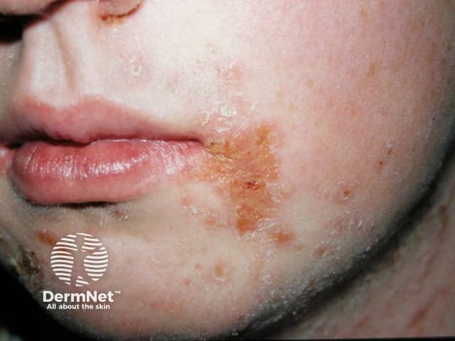 Perioral Impetigo Image