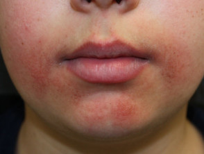 rash under lip
