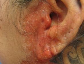 Contact dermatitis to antiseptic used during piercing