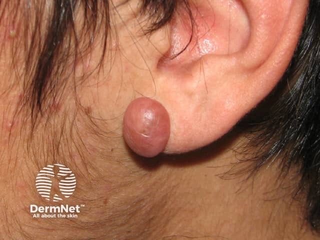 Keloid scar at site of ear piercing