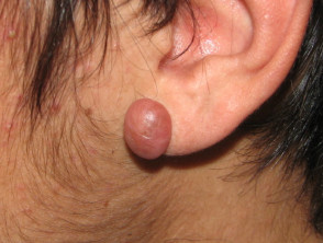 Keloid scar from ear piercing