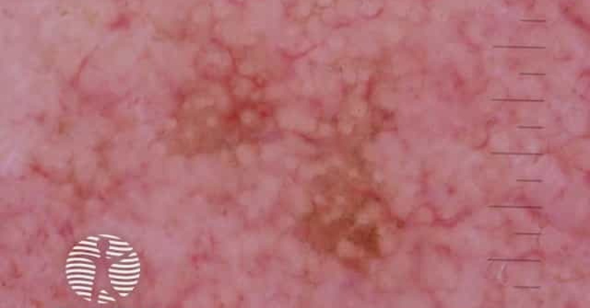 Annular granular pattern seen in pigmented actinic keratosis image