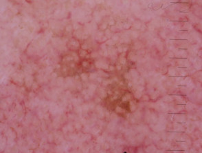 Annular granular pattern seen in pigmented actinic keratosis