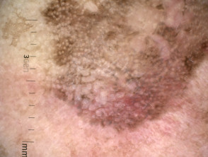 Annular granular pattern seen in dermoscopy of pigmented actinic keratosis