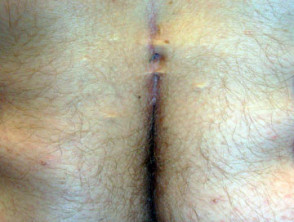 Hole anus pimple near Pimple on
