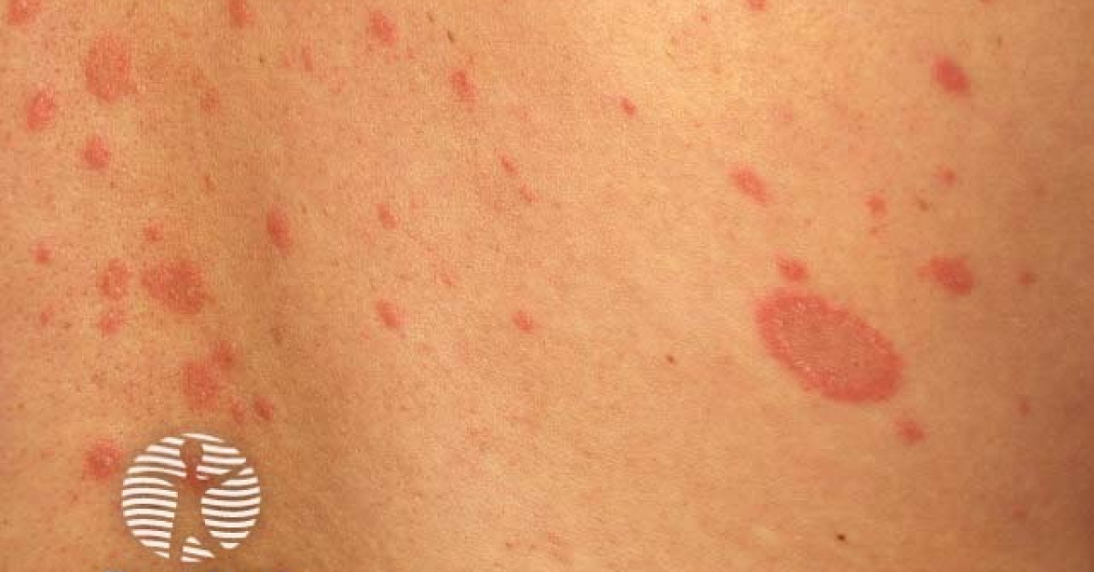 Pityriasis Rosea Image