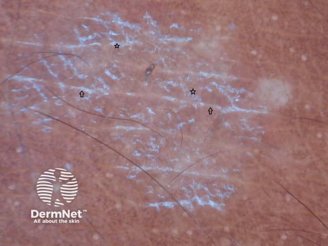 White scale in skin lines (arrows) and diffuse pattern (stars)