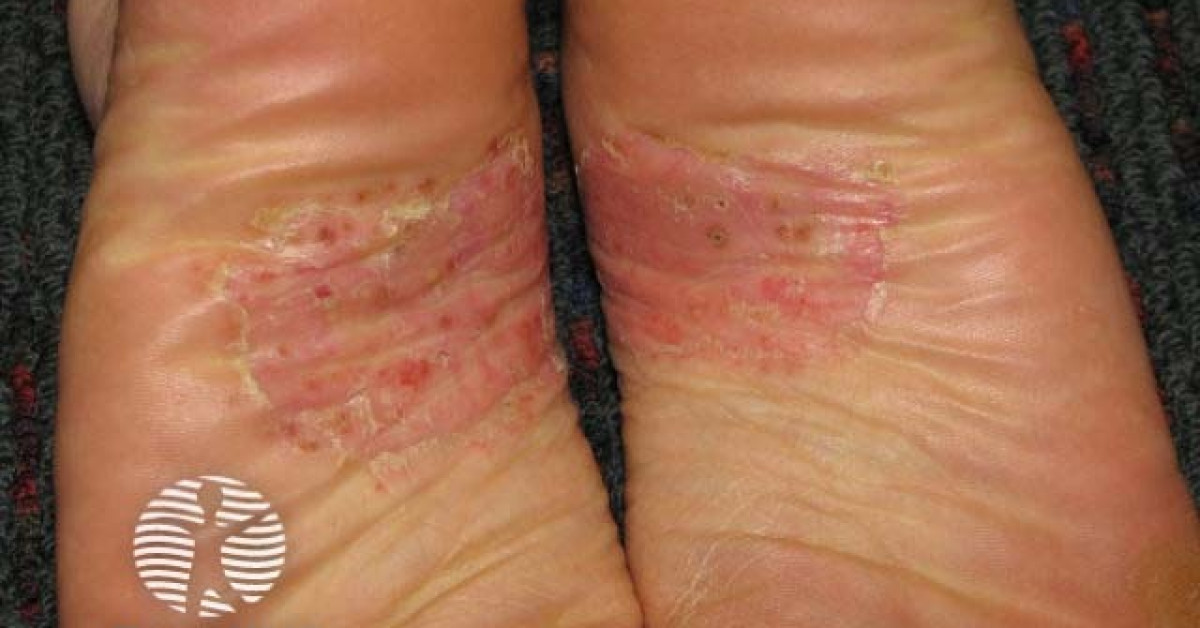 Plantar pustulosis image