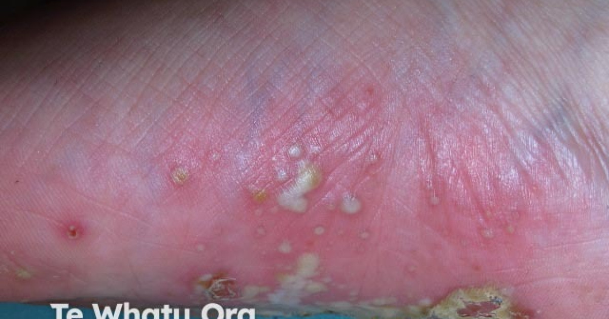 Plantar pustulosis image
