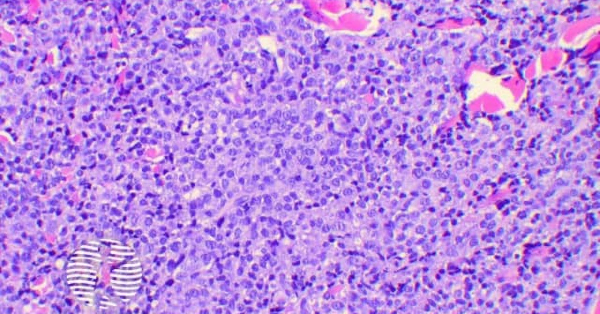 Plasmacytoma histology image