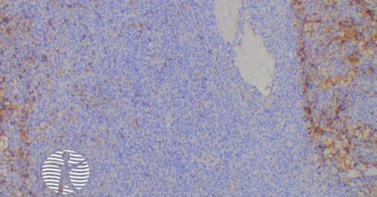 DermNet® - Plasmacytoma histology kappa staining image