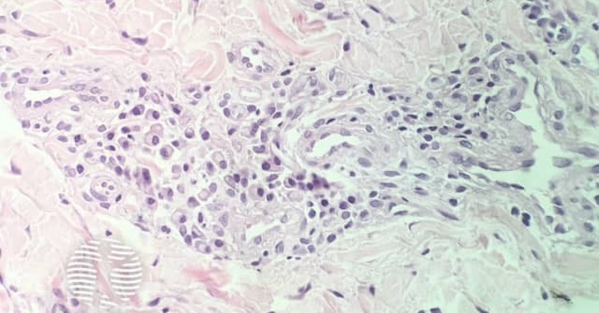 Cutaneous plasmacytosis image