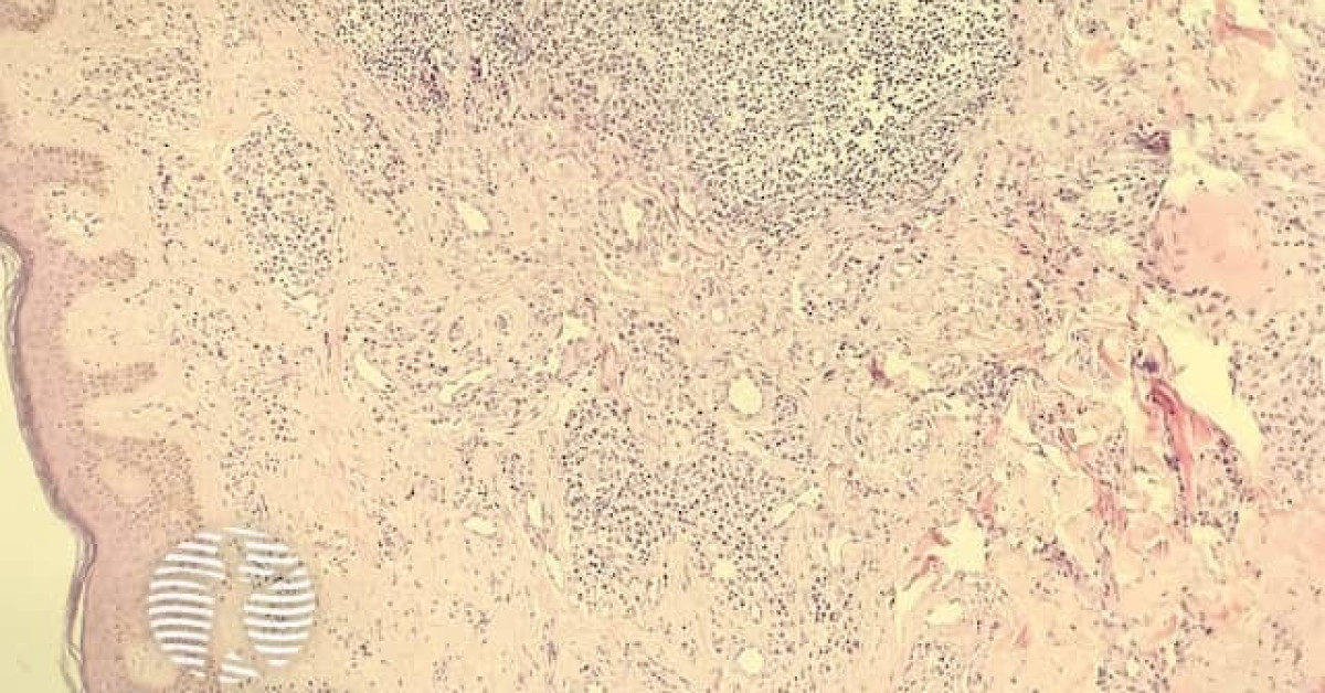 Cutaneous plasmacytosis image