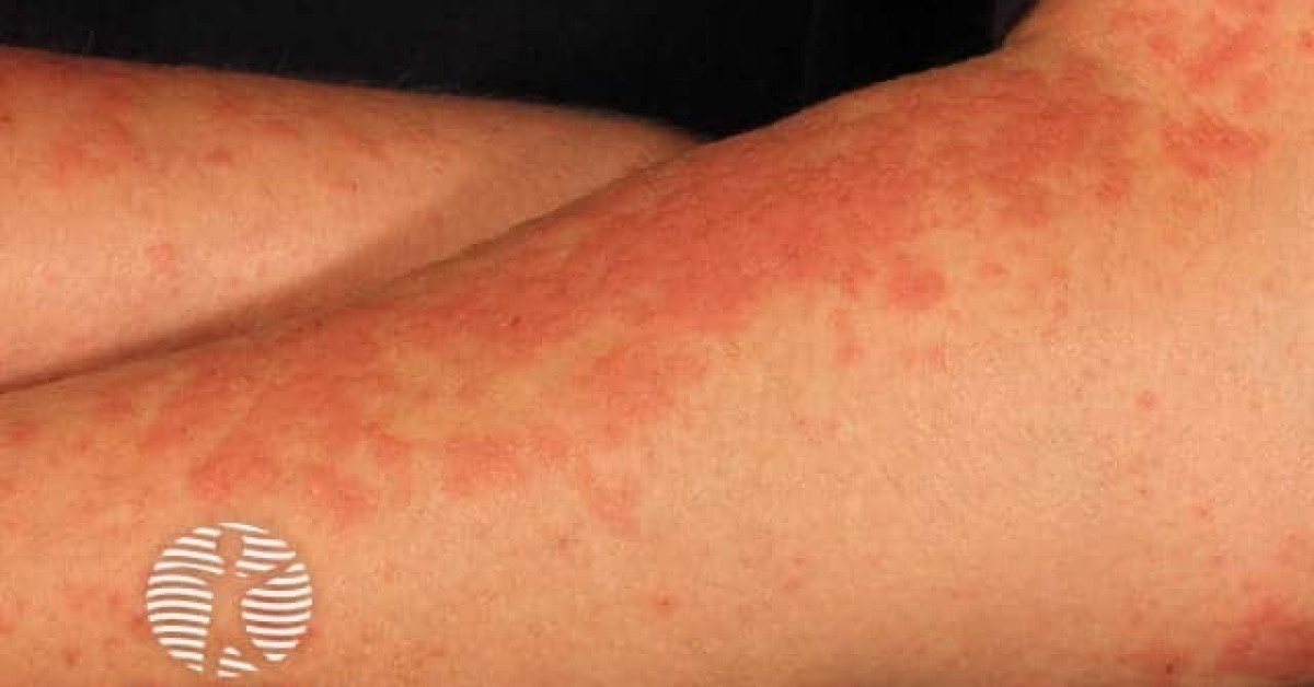 Polymorphic light eruption image