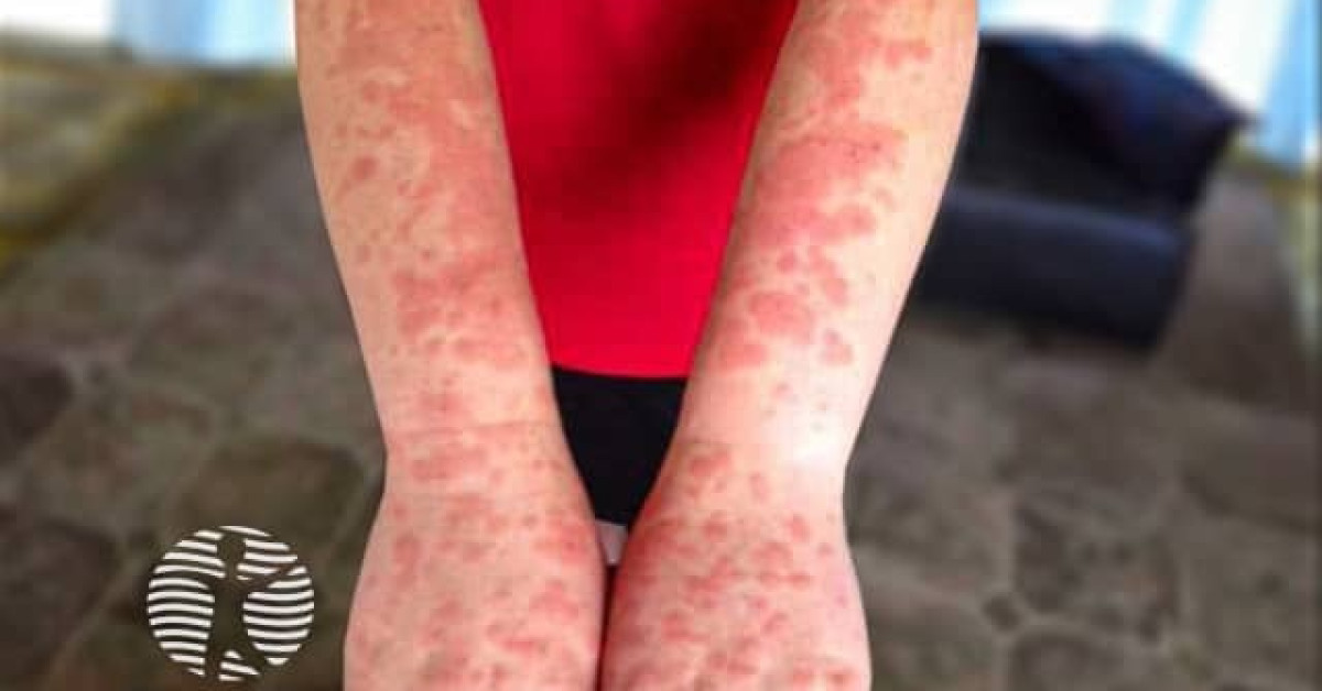 Polymorphic light eruption image