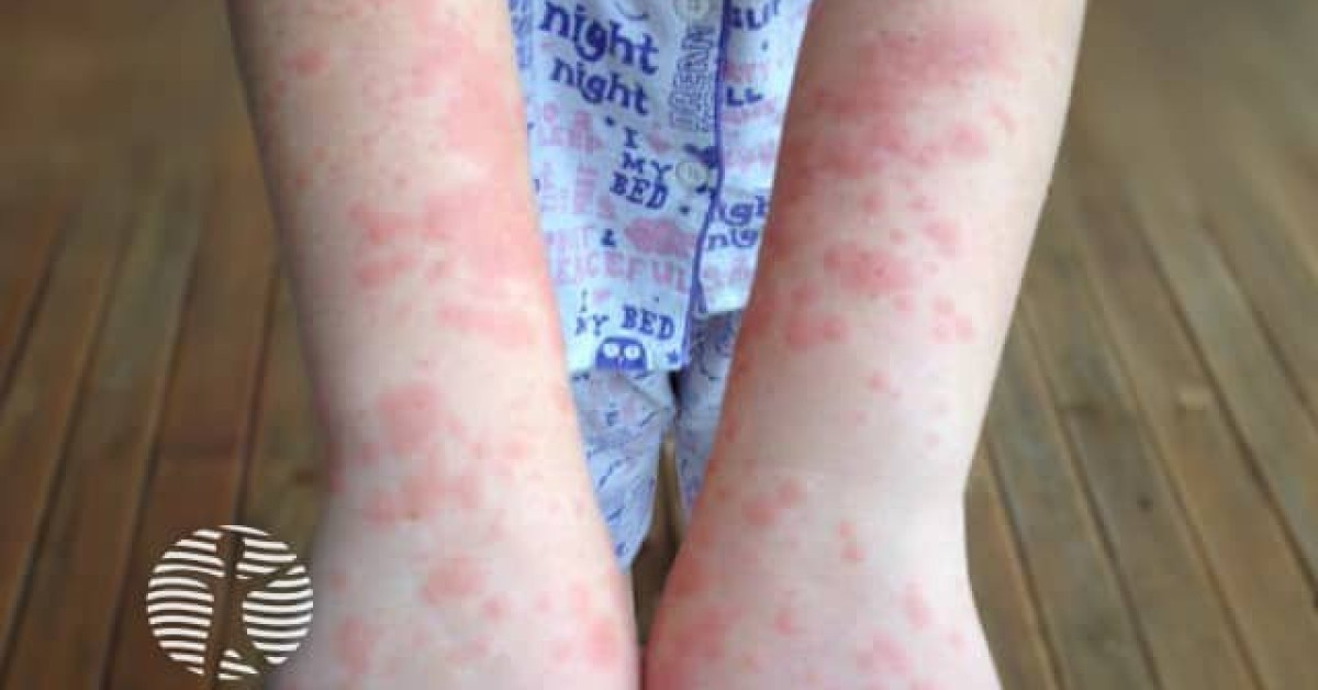 Polymorphic light eruption image