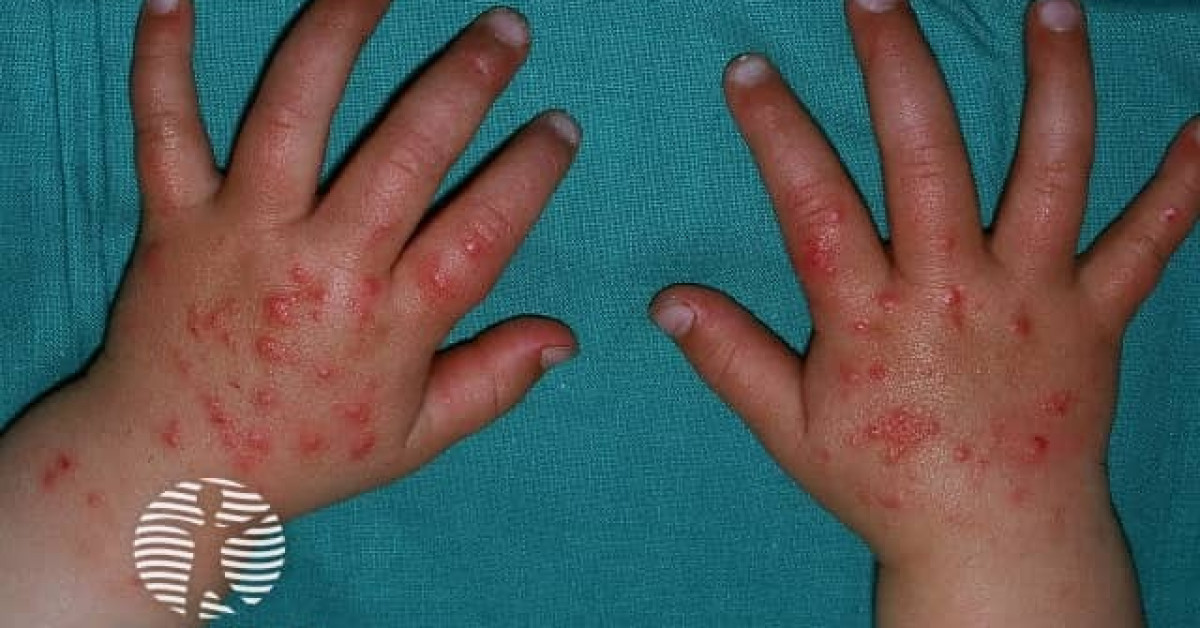 Polymorphic light eruption image