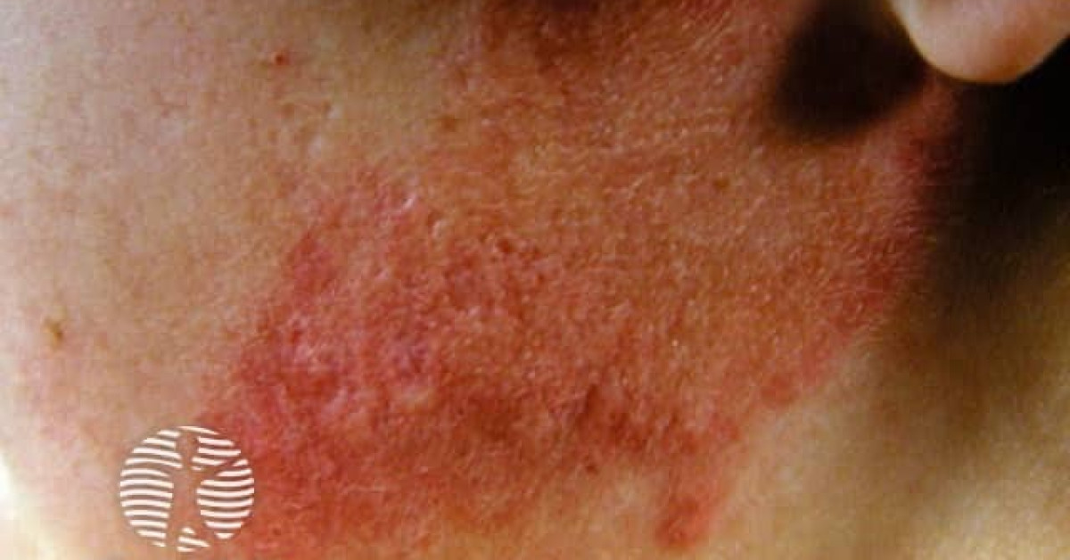 Polymorphic light eruption image