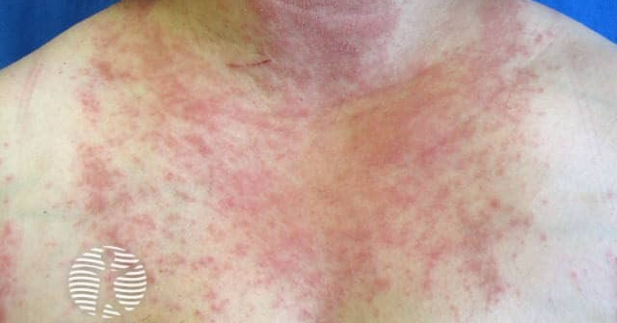 Polymorphic light eruption image