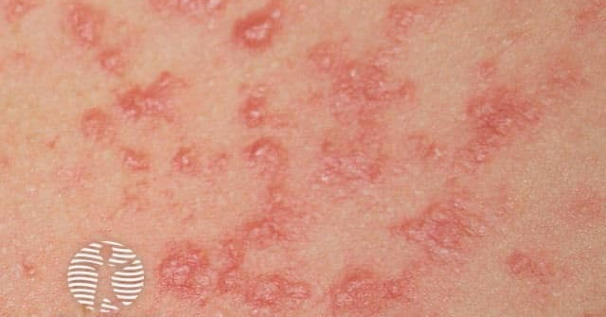 Polymorphic light eruption image