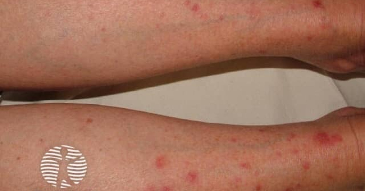 Polymorphic Rash Cellulitis Polymorphic light eruption image