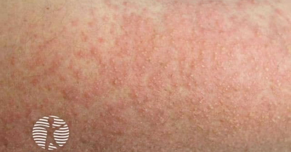 Polymorphic light eruption image