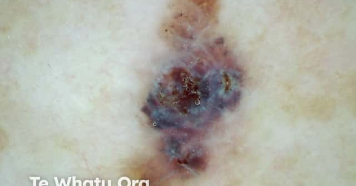 Polarised dermoscopy of melanoma image