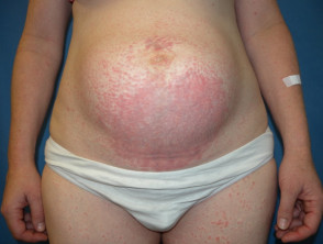 What's PUPPP Rash? All About Pregnancy Rashes