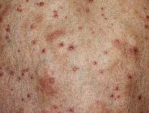 Primary cutaneous anaplastic large cell lymphoma
