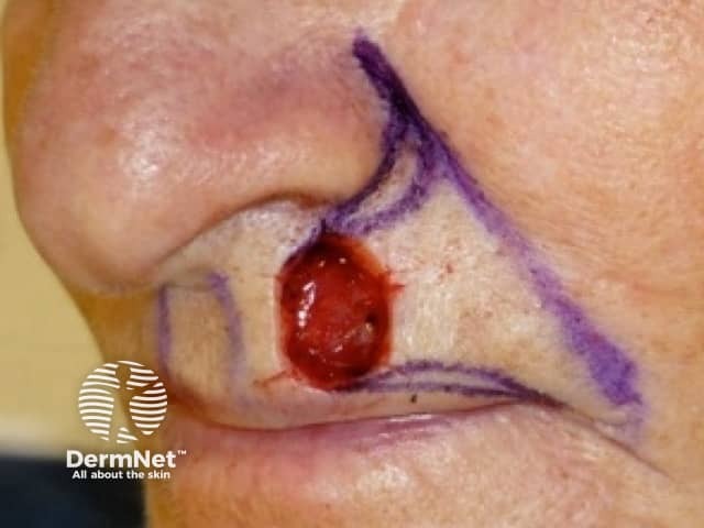 Excision wound marked out for advancement flap repair