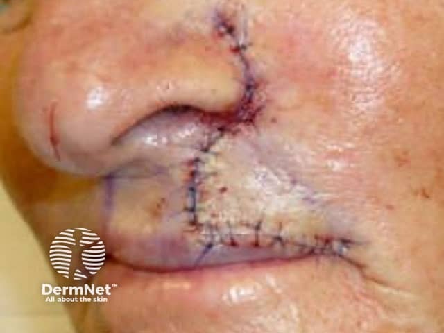 Sutured wound after advancement flap