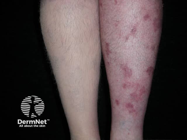Psoriasis disguised by cosmetic camouflage on right leg