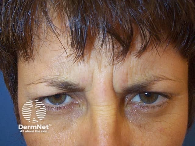 Subject frowning prior to botulinum toxin injectons