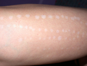Hypopigmentation from laser hair removal