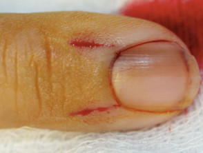Nail biopsy