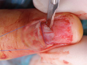 Nail biopsy