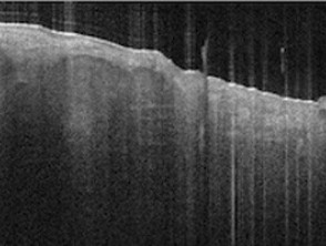 Optical coherence tomography: epidermal and dermal structures
