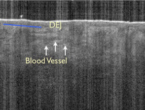 Optical coherence tomography: epidermal and dermal structures
