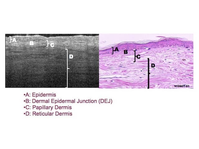 Epidermal and dermal layers on OCT (left) and histopathology (right)