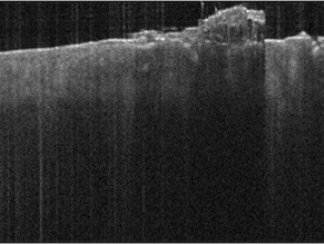Optical coherence tomography: actinic keratosis