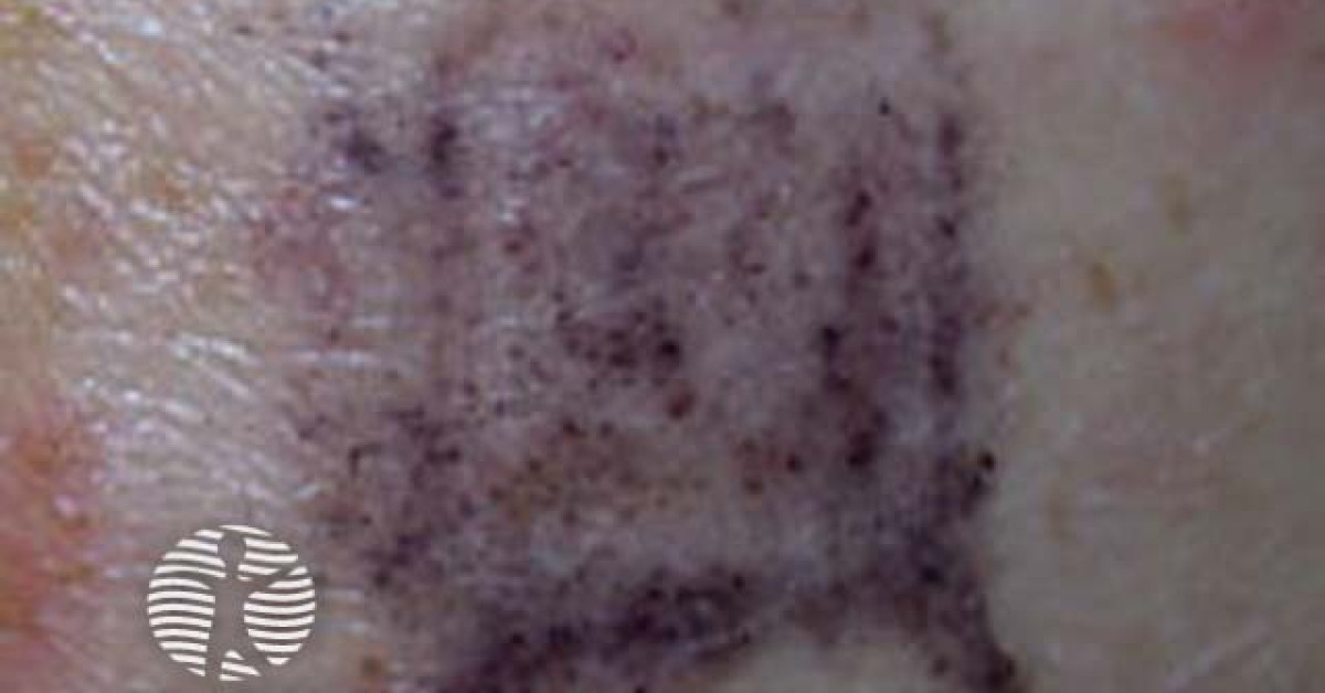Patch Result Example Patch tests image