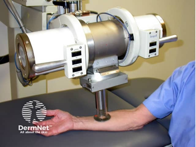 Radiation therapy being administed to a skin cancer on the arm