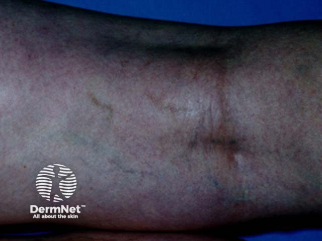 After sclerotherapy