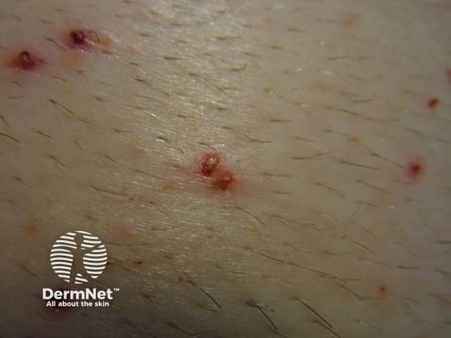 Close-up surgical shaving rash