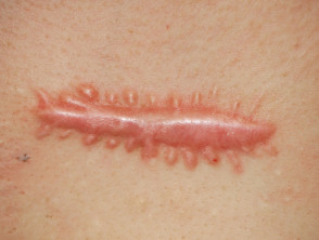 Hypertrophic surgical scar