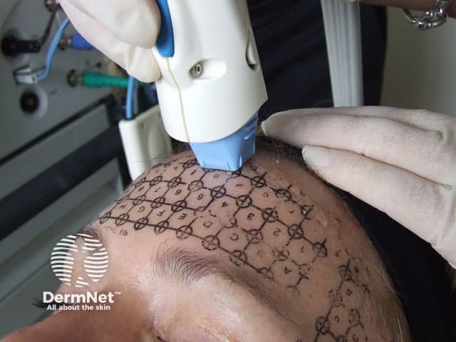 Treatment of brow