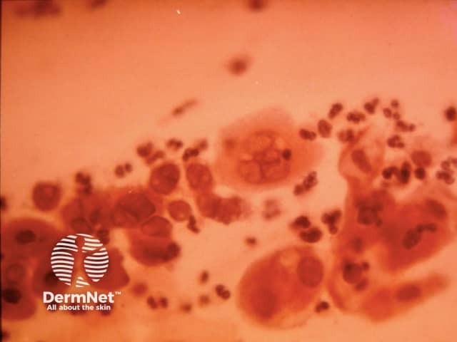 Tzanck smear of herpes simplex