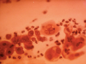 Tzanck smear of herpes simplex