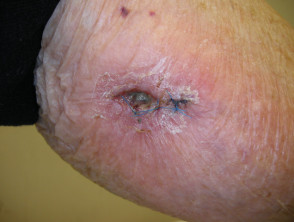 Surgical wound dehiscence