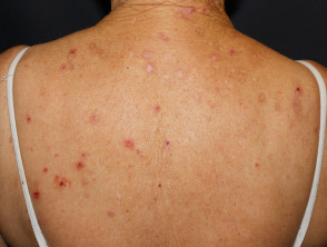 Skin of haematological diseases DermNet NZ